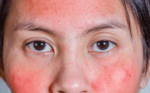 Read more about the article Causes of redness of face
